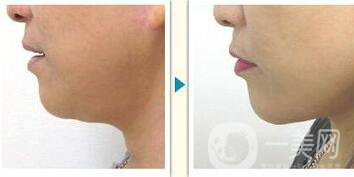 南京溶脂手術(shù)多少錢