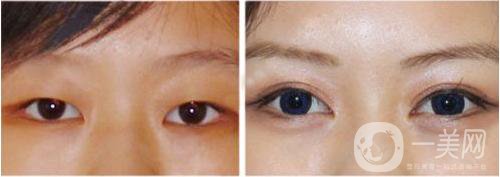 割雙眼皮多久時間后恢復(fù)正常