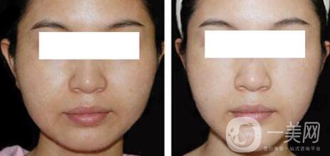 光纖溶脂減肥*果*嗎