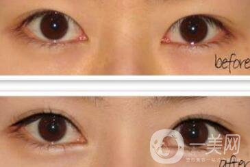 割雙眼皮加開眼角*果怎么樣