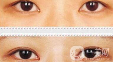 割雙眼皮加開眼角*果怎么樣