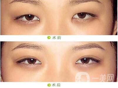 北京開眼角,開眼角介紹