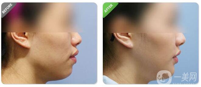 顴骨突出怎么辦 術(shù)后注意事項 2