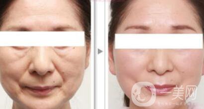 杭州電波拉皮術需要多少錢