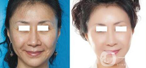 杭州電波拉皮術需要多少錢