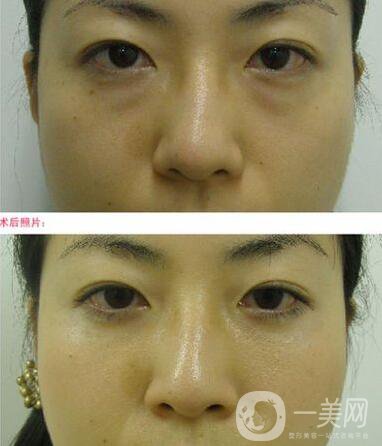 電波拉皮去眼袋*果怎么樣？