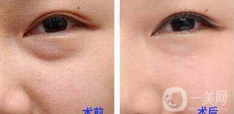 電波拉皮去眼袋*果怎么樣？