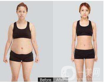 溶脂減肥手術(shù),上海溶脂減肥手術(shù)價格,上海溶脂減肥手術(shù)注意事項