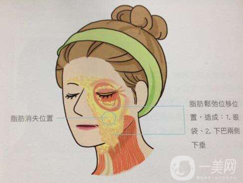 冰電波拉皮好嗎？冰電波拉皮優(yōu)勢！