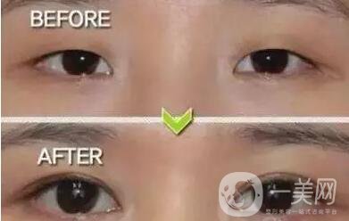 開眼角多少錢,成都開眼角多少錢