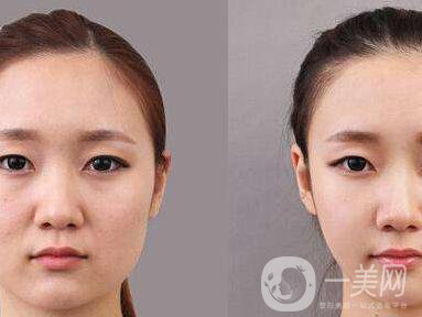 顴骨肉怎么消？怎么縮小顴骨？