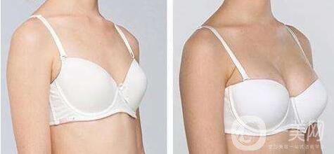 法國es假體隆胸多少錢,法國es假體隆胸價格分析