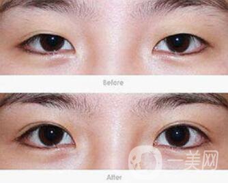 上海開眼角價格是多少