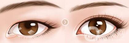 上海開眼角價格是多少