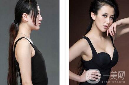 假體豐胸能大多少錢？