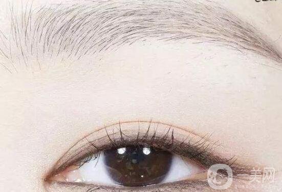 雙眼皮,雙眼皮適合人群