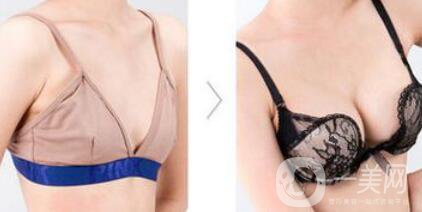 假體隆胸恢復期要多長時間