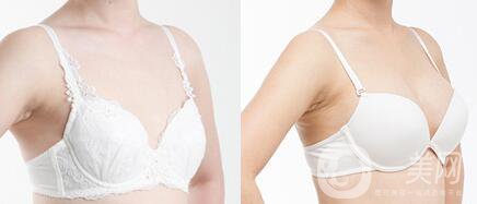 假體隆胸恢復期要多長時間