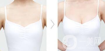 假體豐胸后什么不能吃