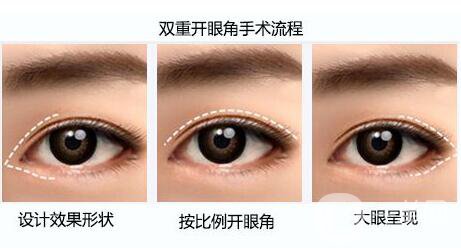 開眼角,開眼角多少錢,開眼角增生