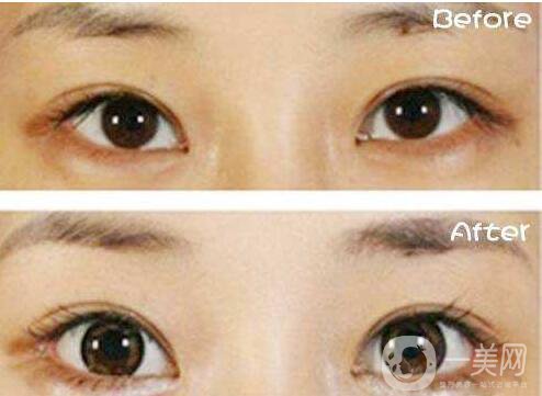 開眼角,開眼角多少錢,開眼角增生