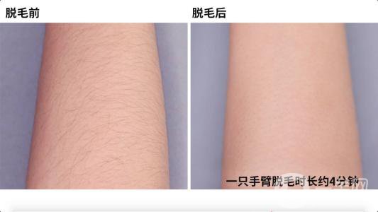 北京激光脫毛一般需要多少錢 術后怎么護理