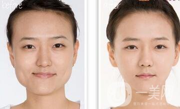 做過顴骨和下顎角手術(shù)后的感受