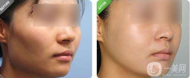 降低顴骨,降低顴骨方法,降低顴骨術(shù)后護(hù)理