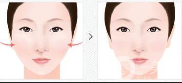 顴骨吸脂后會下垂嗎