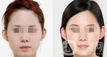 顴骨吸脂后會下垂嗎