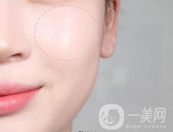 北京自體脂肪豐蘋果肌手術(shù)一般多少錢