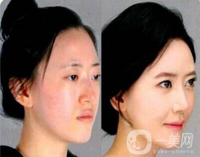 北京自體脂肪豐蘋果肌手術(shù)一般多少錢