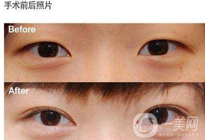 開眼角,開眼角優(yōu)勢(shì),哪里開眼角好