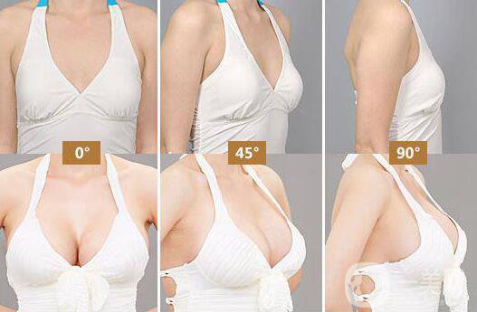 假體隆胸后感覺好嗎