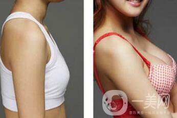 北京假體隆胸*果怎么樣