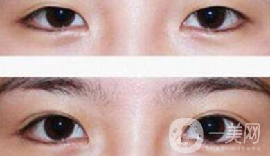 割雙眼皮為什么會(huì)成肉條