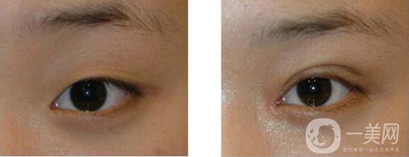 昆明割雙眼皮多少錢