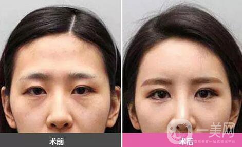 廣東自體脂肪填充淚溝多少錢？