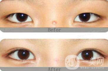 割雙眼皮為什么會(huì)成肉條