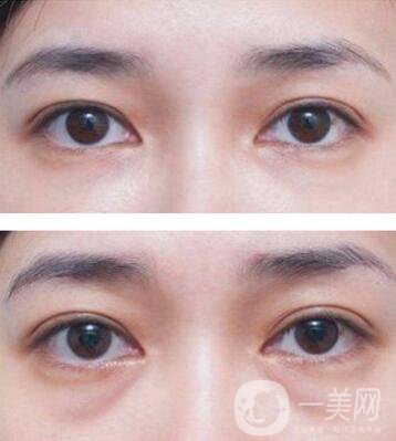 廣東自體脂肪填充淚溝多少錢？