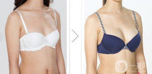 北京假體豐胸取出得多少錢