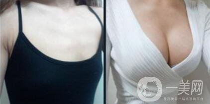 上海假體隆胸的價格高嗎？要多少錢