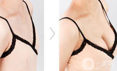 上海假體隆胸的價格高嗎？要多少錢