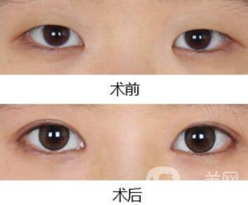 做開眼角手術(shù)前后注意事項(xiàng)具體是什么