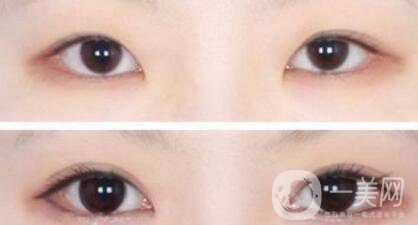 做開眼角手術(shù)前后注意事項(xiàng)具體是什么