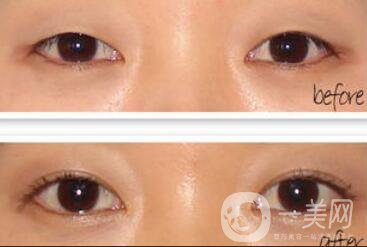 做開眼角手術(shù)前后注意事項(xiàng)具體是什么