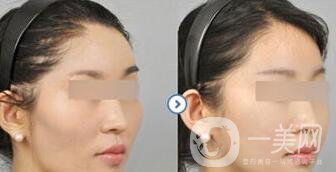 磨顴骨多久能恢復(fù) 磨顴骨價(jià)格多少