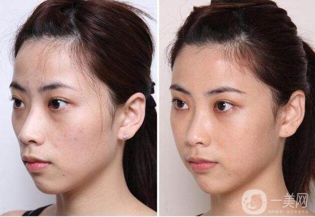 膠原蛋白豐蘋果肌,膠原蛋白豐蘋果肌*果,膠原蛋白豐蘋果肌價格