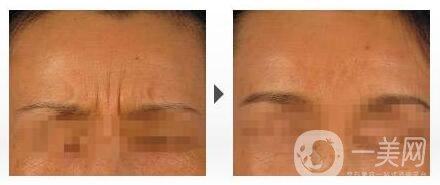 *去眉間紋,深圳*去眉間紋多少錢,*去眉間紋注意事項