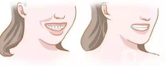 頜骨矯正,北京頜骨矯正價格,頜骨矯正注意事項